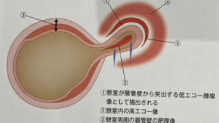 憩室炎の勉強