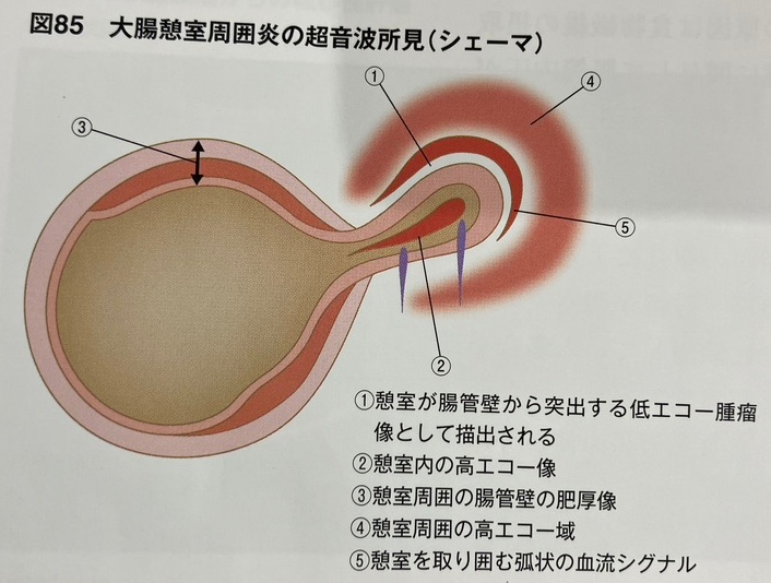 憩室炎の勉強
