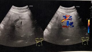 門脈圧亢進？の症例のCT結果とERCP結果