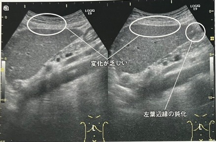 フィブロスキャン以外で肝臓の硬さの推定方法
